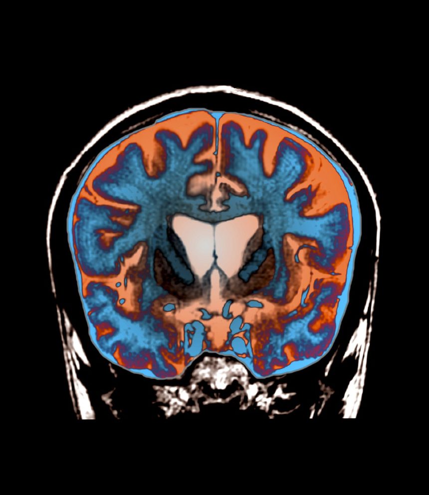 How Scientists Finally Found a Treatment that Slows Huntington’s Disease