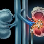 Magnetic gel could remove kidney stones more effectively Magnetic gel could remove kidney stones more effectively