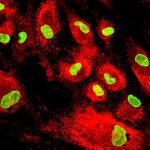 Stem cell therapy lowers risk of heart failure after a heart attack