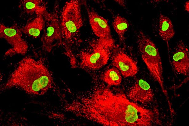 Stem cell therapy lowers risk of heart failure after a heart attack