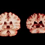 Men’s Brains Shrink Faster than Women’s. What That Means for Alzheimer’s
