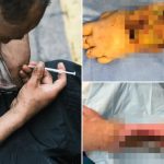 Horrifying images show how flesh-eating ‘zombie’ drug ‘mummifies’ addicts — and causes their limbs to drop off
