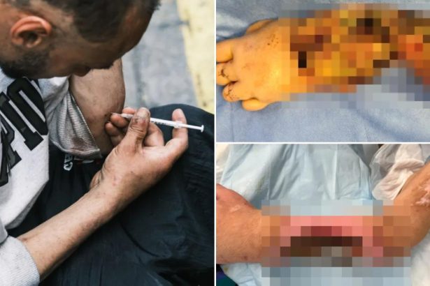 Horrifying images show how flesh-eating ‘zombie’ drug ‘mummifies’ addicts — and causes their limbs to drop off