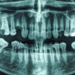 21-Year Study Links Gum Disease And Cavities to Higher Stroke Risk : ScienceAlert