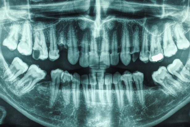 21-Year Study Links Gum Disease And Cavities to Higher Stroke Risk : ScienceAlert