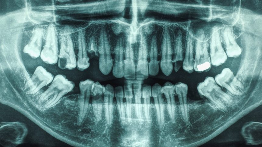 21-Year Study Links Gum Disease And Cavities to Higher Stroke Risk : ScienceAlert
