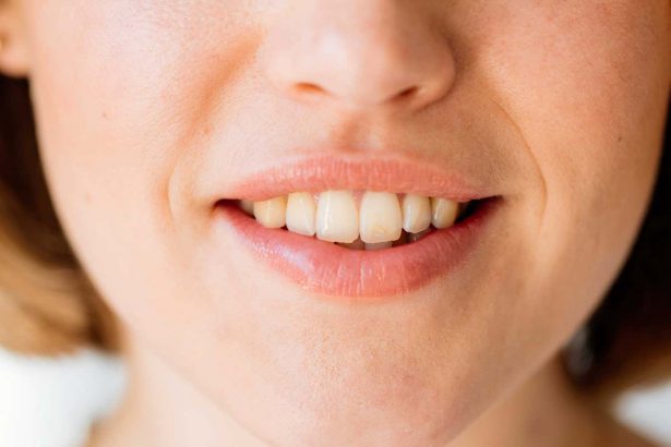 Cavities could be prevented by a gel that restores tooth enamel
