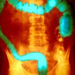 Common type of inflammatory bowel disease linked to toxic bacteria