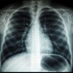 Digital health outreach can improve lung cancer screening
