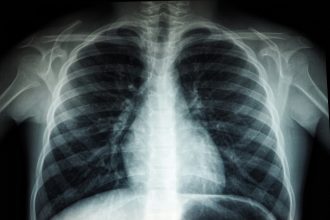 Digital health outreach can improve lung cancer screening