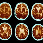 GLP-1 Pill Fails to Slow Alzheimer’s Progression in Clinical Trial