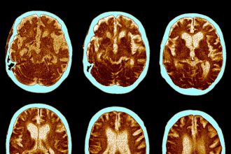GLP-1 Pill Fails to Slow Alzheimer’s Progression in Clinical Trial