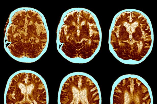 GLP-1 Pill Fails to Slow Alzheimer’s Progression in Clinical Trial