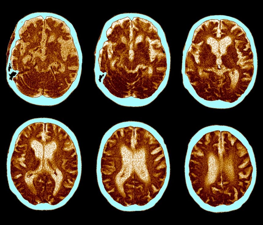 GLP-1 Pill Fails to Slow Alzheimer’s Progression in Clinical Trial