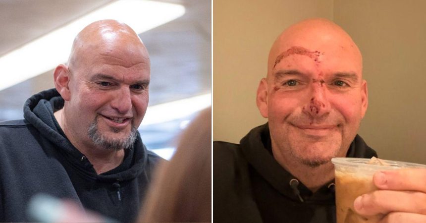 John Fetterman Shows Off Horrific Stitches and Facial Injuries After Fall