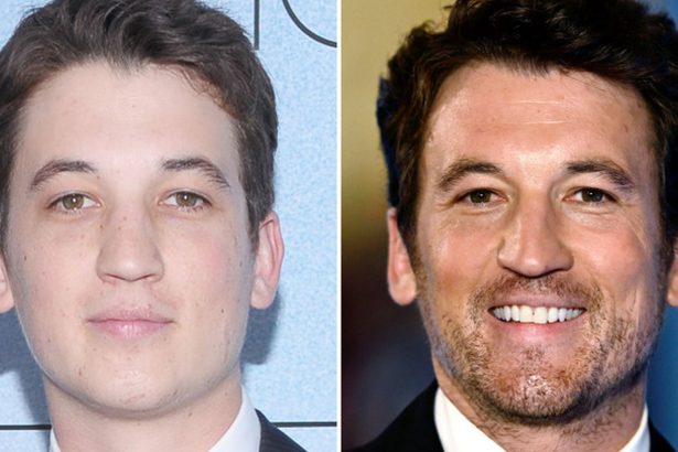 Miles Teller — Good Genes or Good Docs?!