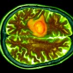 Nasal Drops Could Help Fight a Common And Deadly Brain Cancer : ScienceAlert