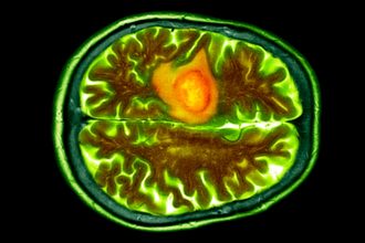 Nasal Drops Could Help Fight a Common And Deadly Brain Cancer : ScienceAlert