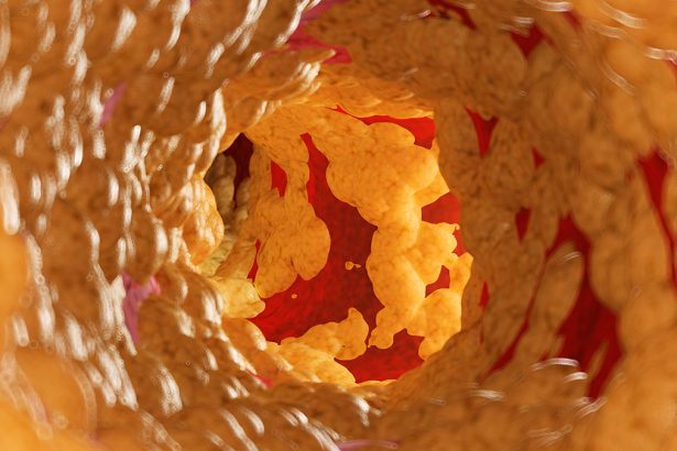 New Drug Lowers ‘Bad’ Cholesterol by 58% in Clinical Trial : ScienceAlert