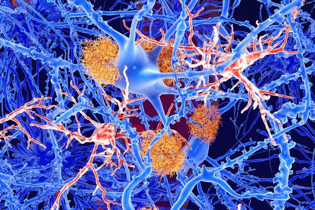 One of Our Biggest Hopes For Alzheimer’s Treatment Doesn’t Seem to Work : ScienceAlert