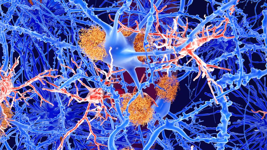 One of Our Biggest Hopes For Alzheimer’s Treatment Doesn’t Seem to Work : ScienceAlert