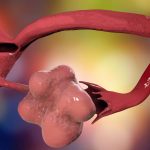 Polycystic ovary syndrome: We’re closing in on how genetics causes PCOS