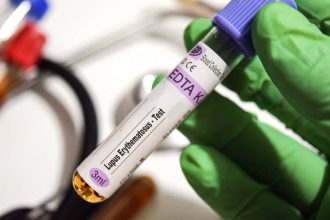 Strongest evidence yet that the Epstein-Barr virus causes lupus