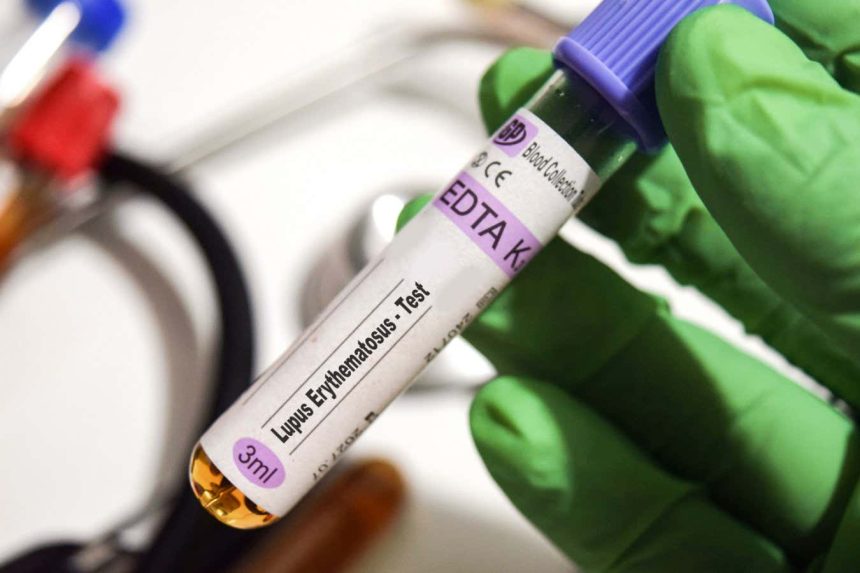 Strongest evidence yet that the Epstein-Barr virus causes lupus