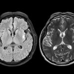 Study Suggests COVID Pandemic May Have Aged Everyone’s Brain