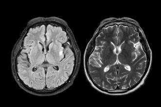 Study Suggests COVID Pandemic May Have Aged Everyone’s Brain