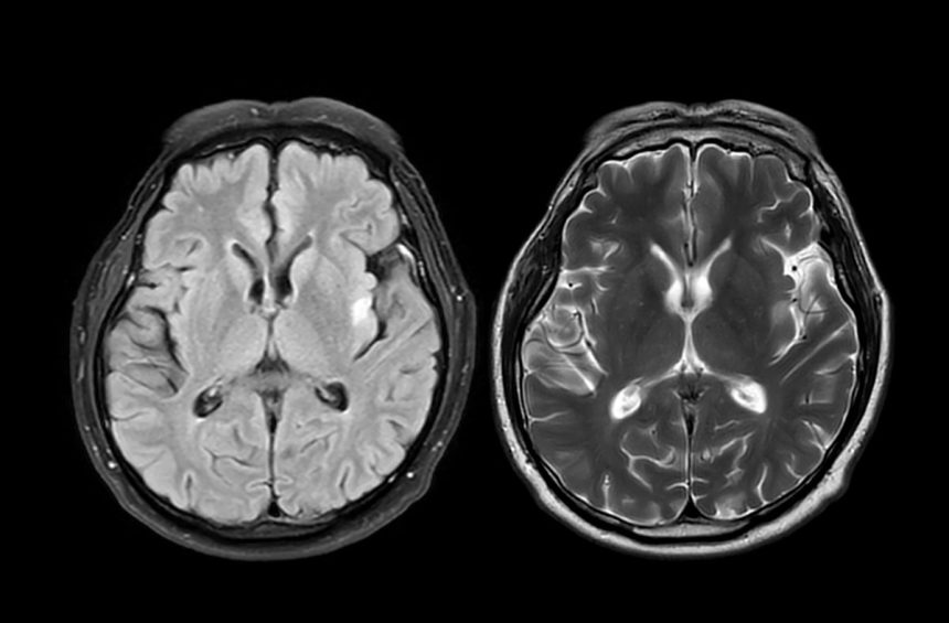 Study Suggests COVID Pandemic May Have Aged Everyone’s Brain