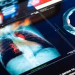 Vanishing Y chromosomes could aid or worsen lung cancer outcomes