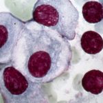 A promising sickle cell pill and a new way to treat myelofibrosis