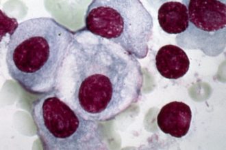 A promising sickle cell pill and a new way to treat myelofibrosis