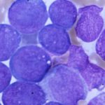 At ASH, positive news for Terns, Kura leukemia treatments