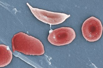 Fulcrum sickle cell pill data at ASH: Higher dose works better