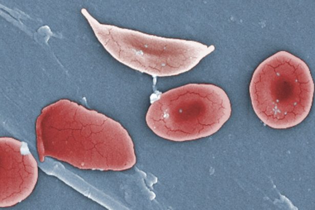 Fulcrum sickle cell pill data at ASH: Higher dose works better