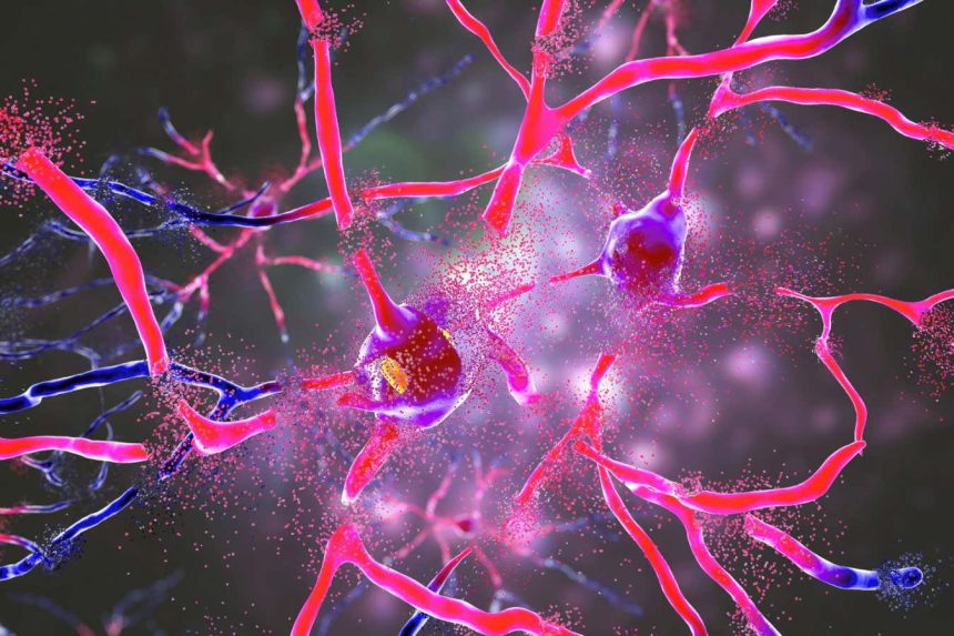 Gene therapy for Huntington’s disease showed great promise in 2025