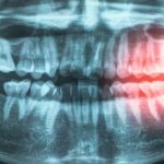 Gum Disease Linked to Heart Risks : ScienceAlert