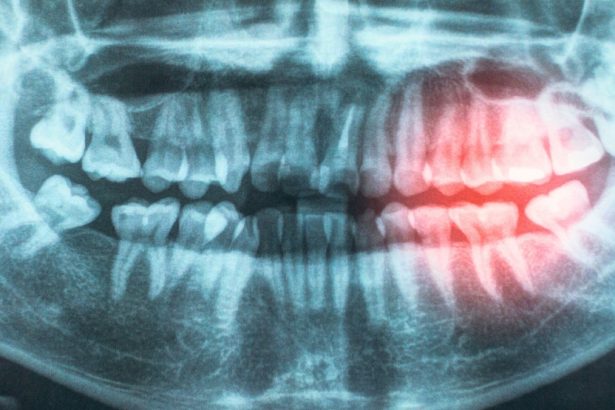 Gum Disease Linked to Heart Risks : ScienceAlert
