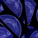 Mammograms, gonorrhea, gen AI: Morning Rounds