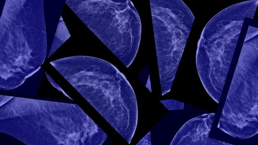 Mammograms, gonorrhea, gen AI: Morning Rounds