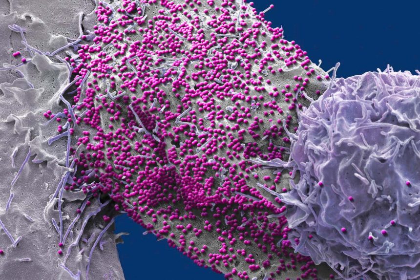 Man unexpectedly cured of HIV after stem cell transplant