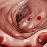 Most People Develop Diverticulosis in Their Gut by Age 80… So What Is It? : ScienceAlert