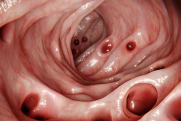 Most People Develop Diverticulosis in Their Gut by Age 80… So What Is It? : ScienceAlert
