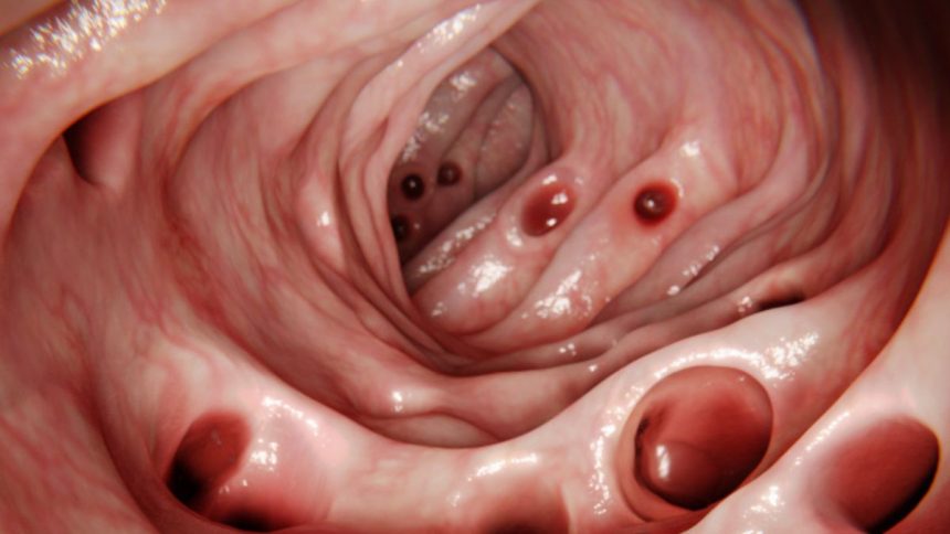 Most People Develop Diverticulosis in Their Gut by Age 80… So What Is It? : ScienceAlert