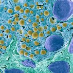 New Cell Transplant Therapy Restores Insulin Production in Patient with Type 1 Diabetes