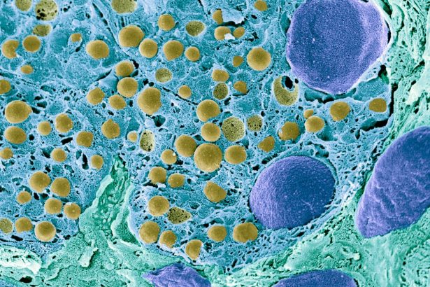 New Cell Transplant Therapy Restores Insulin Production in Patient with Type 1 Diabetes