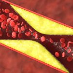 Over 50% of Heart Attacks in Younger Women Aren’t From Clogged Arteries : ScienceAlert