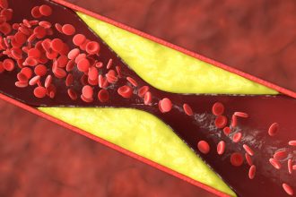 Over 50% of Heart Attacks in Younger Women Aren’t From Clogged Arteries : ScienceAlert